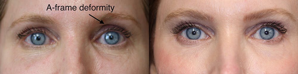  EnigmaLift - Upper Eyelid Surgery Before & After Gallery - Patient 36519739 - Image 1