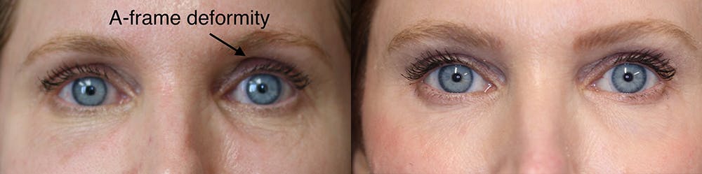 EnigmaLift - Eye Bag Removal Before & After Gallery - Patient 36526983 - Image 1