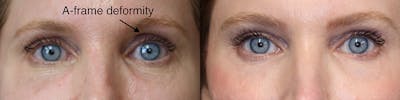 EnigmaLift - Eye Bag Removal Before & After Gallery - Patient 36526983 - Image 1