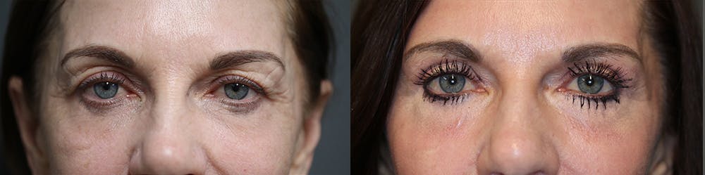 EnigmaLift - Brow Lift Before & After Gallery - Patient 36534133 - Image 2