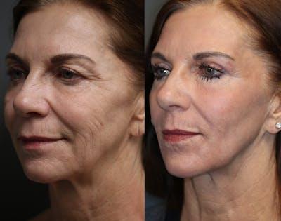  EnigmaLift - Upper Eyelid Surgery Before & After Gallery - Patient 36534162 - Image 1