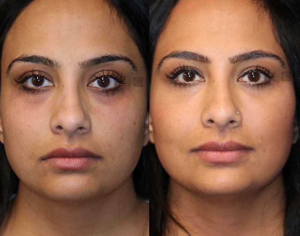 Dermal Fillers Before & After Gallery - Patient 36534204 - Image 1
