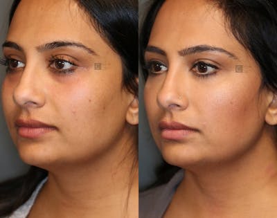 Dermal Fillers Before & After Gallery - Patient 36534204 - Image 2