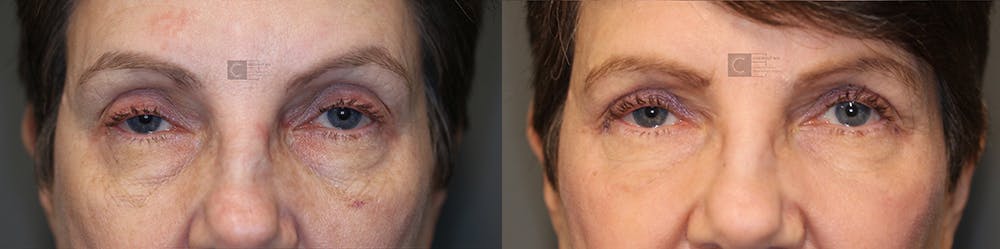 EnigmaLift - Eye Bag Removal Before & After Gallery - Patient 36535111 - Image 1