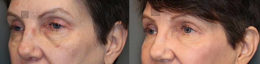 EnigmaLift - Eye Bag Removal Before & After Gallery - Patient 36535111 - Image 2