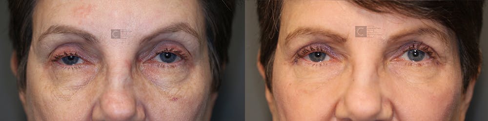 ÔPTIMized Laser Cocktail Before & After Gallery - Patient 36535117 - Image 1