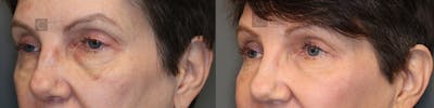 ÔPTIMized Laser Cocktail Before & After Gallery - Patient 36535117 - Image 2