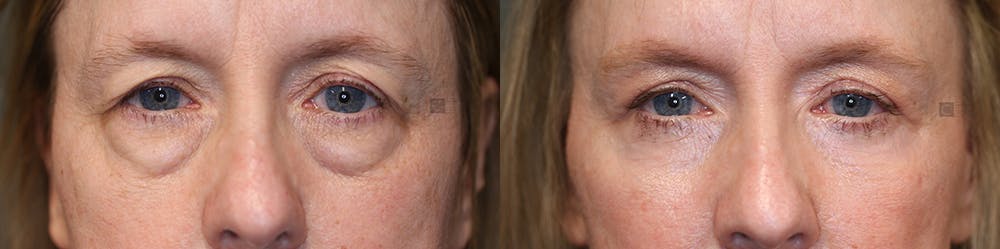 ÔPTIMized Laser Cocktail Before & After Gallery - Patient 36535130 - Image 1