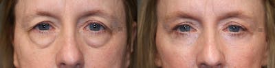 EnigmaLift - Eye Bag Removal Before & After Gallery - Patient 36535132 - Image 1