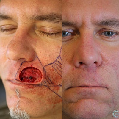 MOHS & Reconstruction Surgery Before & After Gallery - Patient 36543091 - Image 1