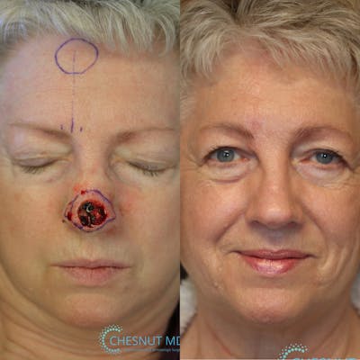 MOHS & Reconstruction Surgery Before & After Gallery - Patient 36543102 - Image 1