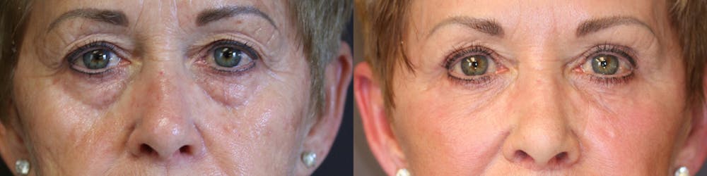 EnigmaLift - Brow Lift Before & After Gallery - Patient 36217404 - Image 1