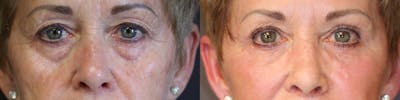 EnigmaLift - Eye Bag Removal Before & After Gallery - Patient 36217482 - Image 1