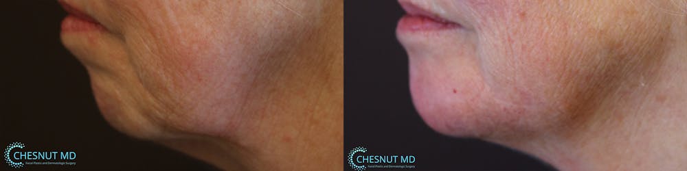 Dermal Fillers Before & After Gallery - Patient 36467032 - Image 1
