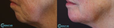 Dermal Fillers Before & After Gallery - Patient 36467032 - Image 1