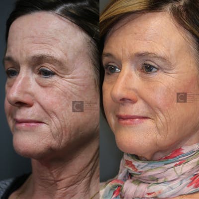 Before & After EnimaLift Eye Bag Removal