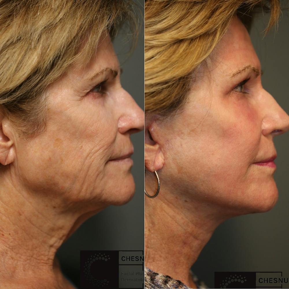 ÔPTIMized Laser Cocktail Before & After Gallery - Patient 37510666 - Image 1