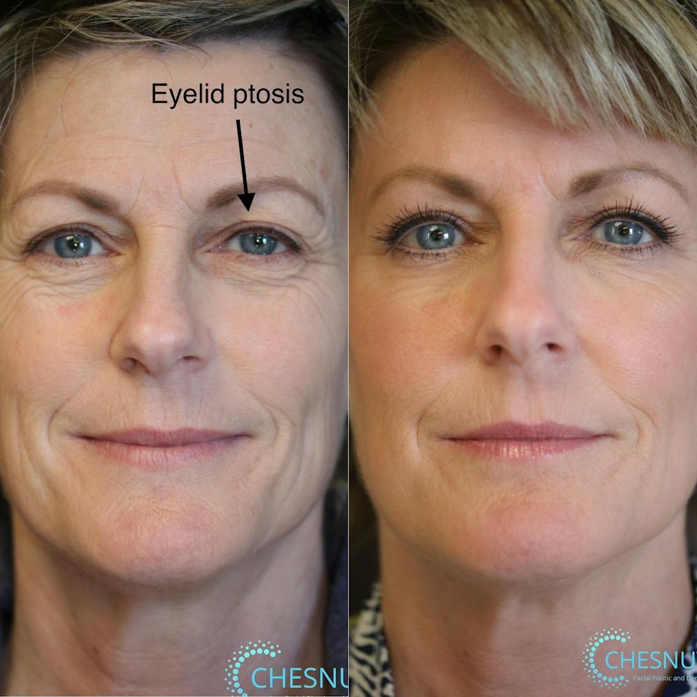  EnigmaLift - Upper Eyelid Surgery Before & After Gallery - Patient 37510712 - Image 1