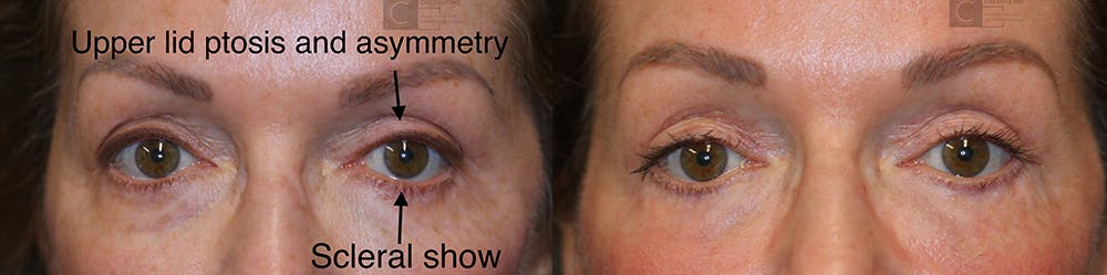  EnigmaLift - Upper Eyelid Surgery Before & After Gallery - Patient 37510722 - Image 1