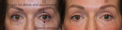  EnigmaLift - Upper Eyelid Surgery Before & After Gallery - Patient 37510722 - Image 1
