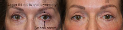 EnigmaLift - Eye Bag Removal Before & After Gallery - Patient 37510728 - Image 1
