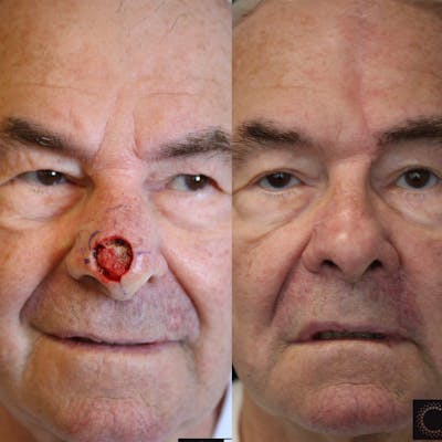 MOHS & Reconstruction Surgery Before & After Gallery - Patient 37510732 - Image 1