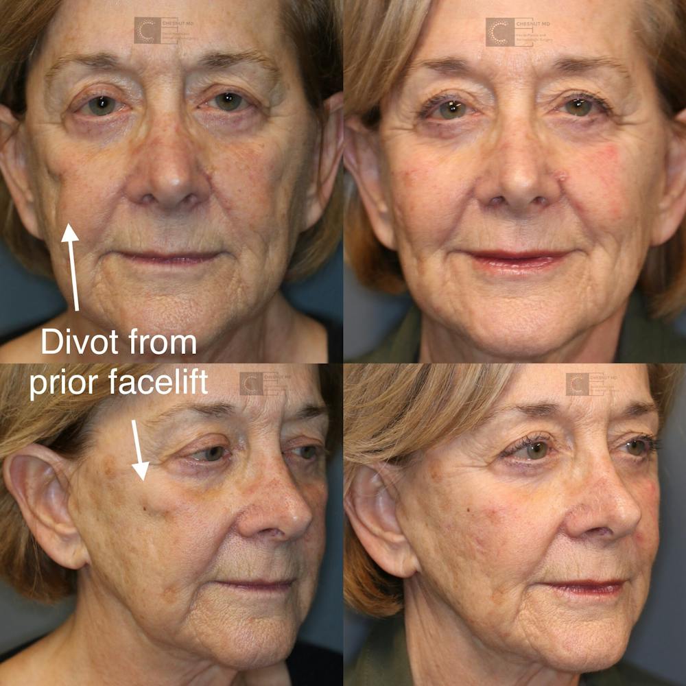 Dermal Fillers Before & After Gallery - Patient 37510741 - Image 1