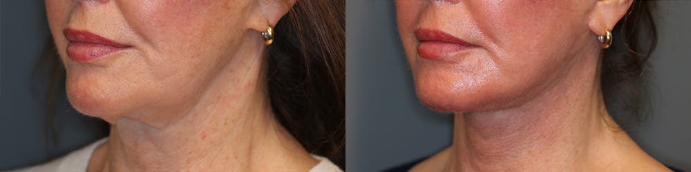 EnigmaLift - Facelift Before & After Gallery - Patient 37518065 - Image 1