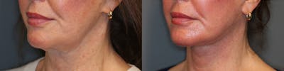EnigmaLift - Facelift Before & After Gallery - Patient 37518065 - Image 1
