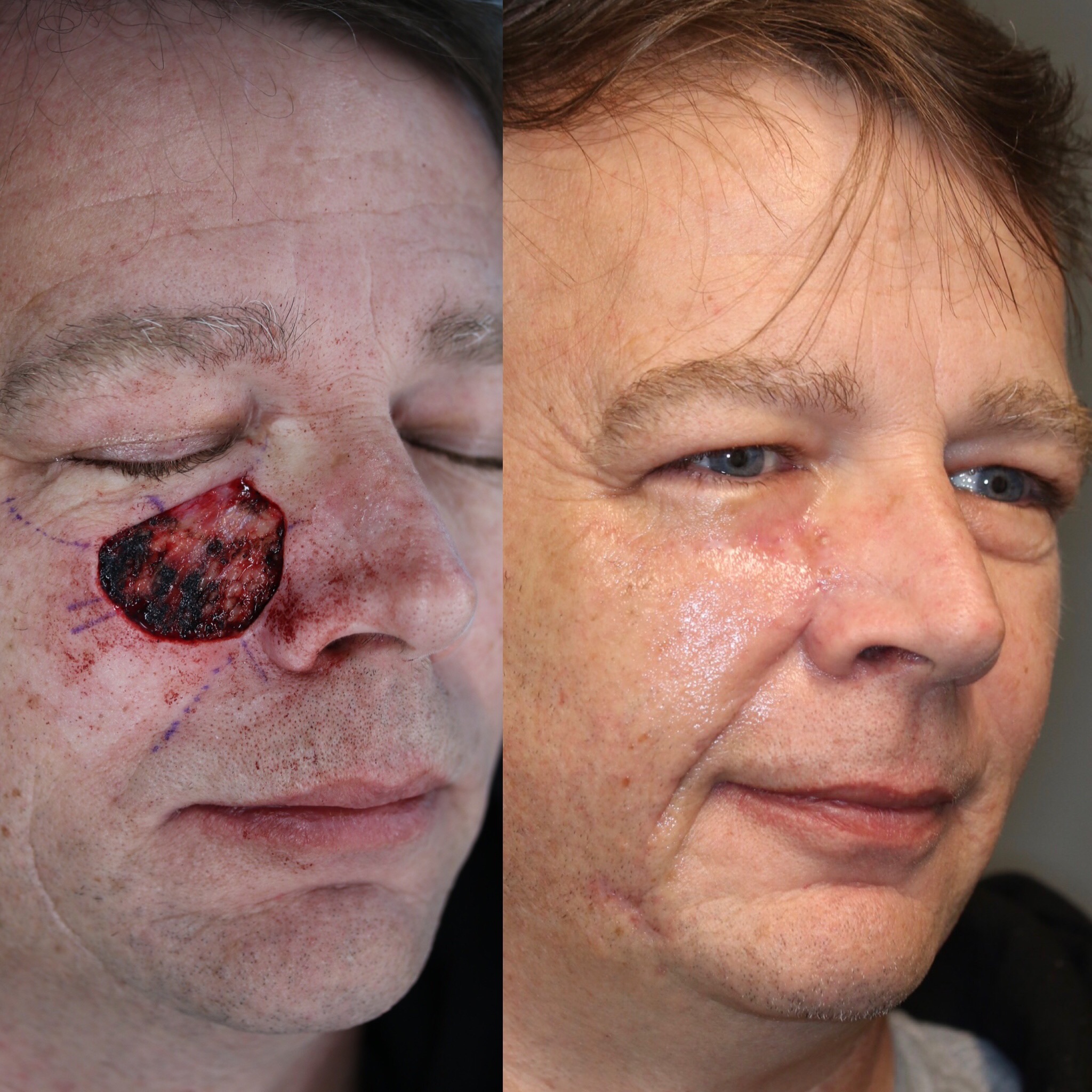 Lower Eyelid/Cheek Reconstruction