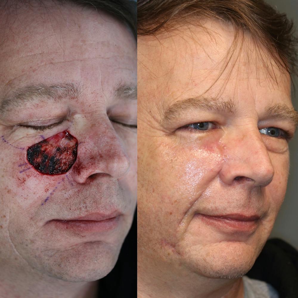 MOHS & Reconstruction Surgery Before & After Gallery - Patient 37525356 - Image 1