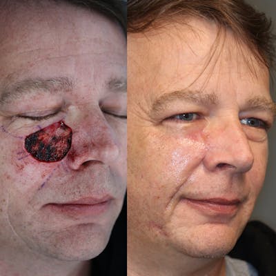 MOHS & Reconstruction Surgery Before & After Gallery - Patient 37525356 - Image 1