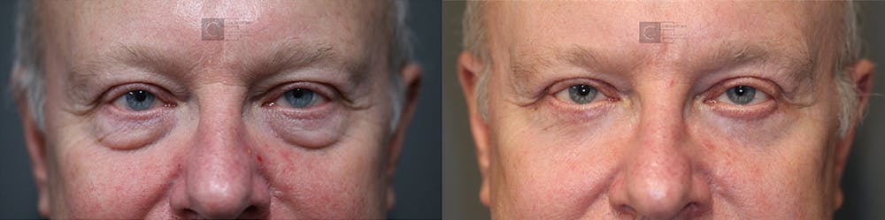 ÔPTIMized Laser Cocktail Before & After Gallery - Patient 37510738 - Image 1