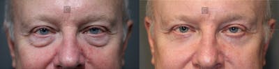 ÔPTIMized Laser Cocktail Before & After Gallery - Patient 37510738 - Image 1