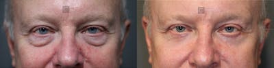 EnigmaLift - Eye Bag Removal Before & After Gallery - Patient 37510739 - Image 1