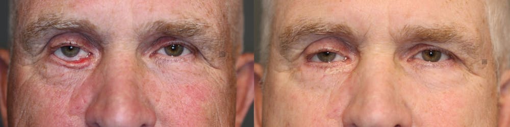 Revision Surgery Before & After Gallery - Patient 41024619 - Image 1