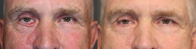 Revision Surgery Before & After Gallery - Patient 41024619 - Image 1