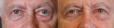 Revision Surgery Before & After Gallery - Patient 41024697 - Image 1