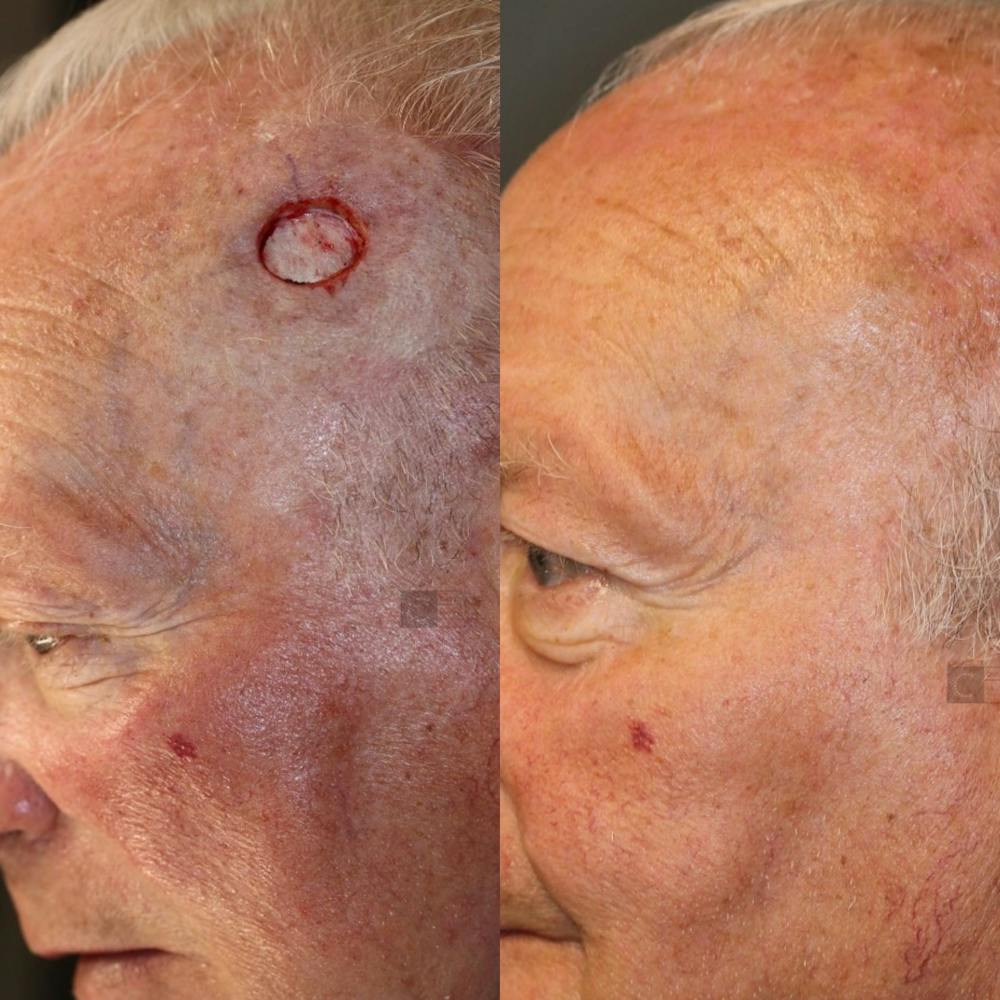 MOHS & Reconstruction Surgery Before & After Gallery - Patient 41037057 - Image 1