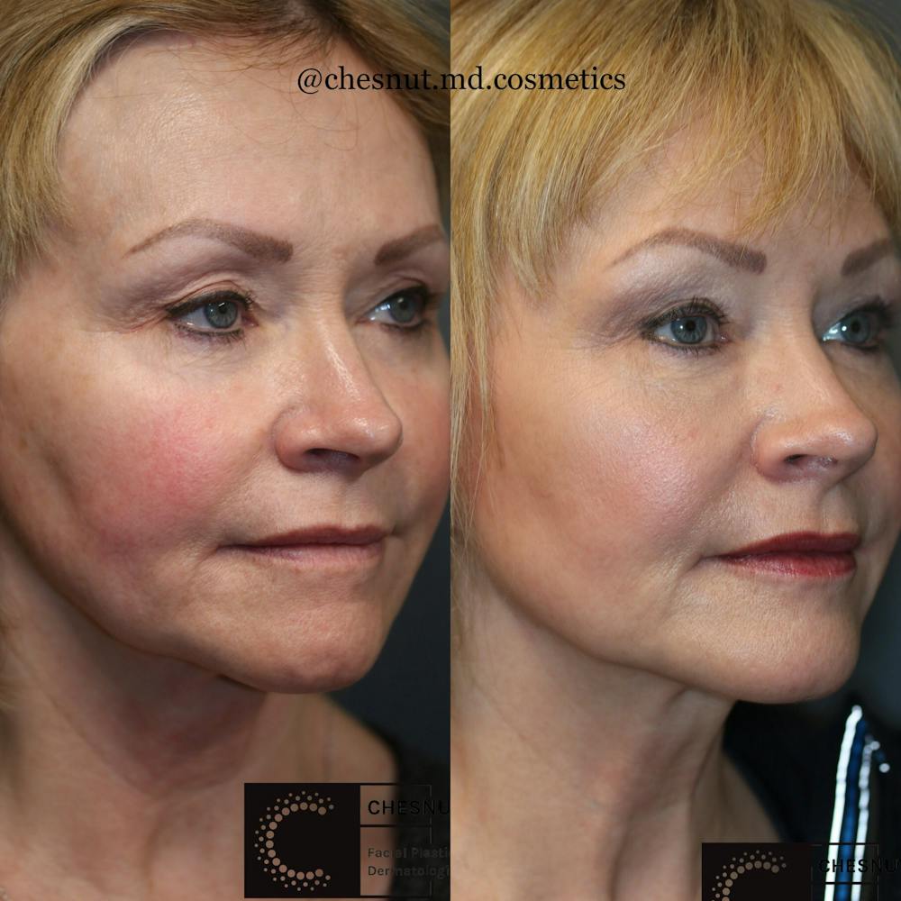 Dermal Fillers Before & After Gallery - Patient 41037225 - Image 1