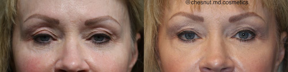 Dermal Fillers Before & After Gallery - Patient 41037225 - Image 2