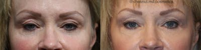 Dermal Fillers Before & After Gallery - Patient 41037225 - Image 2