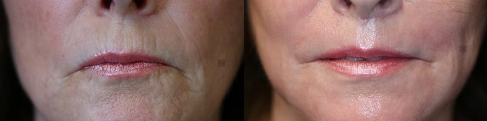 LoveLift - Lip Lift Before & After Gallery - Patient 41308453 - Image 1