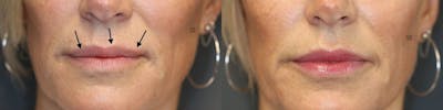 Micro-Structural Lip Augmentation Before & After Gallery - Patient 41308492 - Image 1