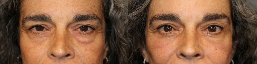  EnigmaLift - Upper Eyelid Surgery Before & After Gallery - Patient 41308575 - Image 1