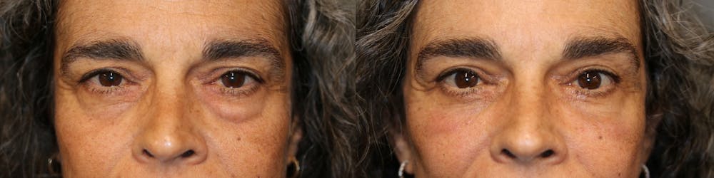 EnigmaLift - Eye Bag Removal Before & After Gallery - Patient 41308626 - Image 1