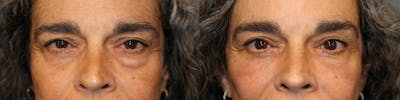 Facial Fat Transfer Before & After Gallery - Patient 41308638 - Image 1