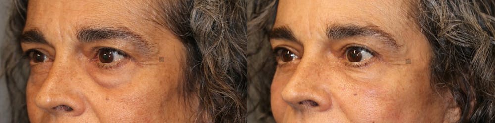ÔPTIMized Facial Fat Transfer Before & After Gallery - Patient 41308638 - Image 2