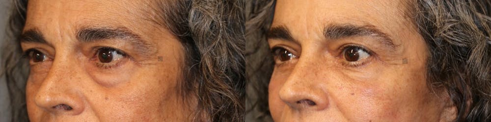 ÔPTIMized Laser Cocktail Before & After Gallery - Patient 41308641 - Image 2