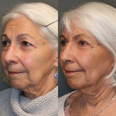 EnigmaLift - Brow Lift Gallery - Patient 41308702 - Image 1